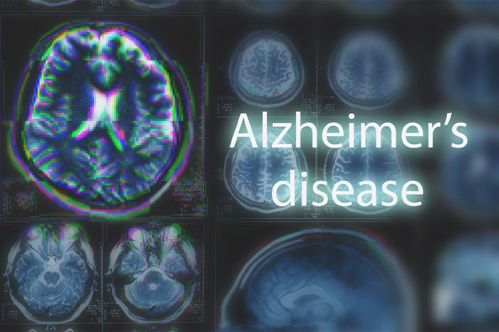 10 Early Signs of Alzheimer’s Disease