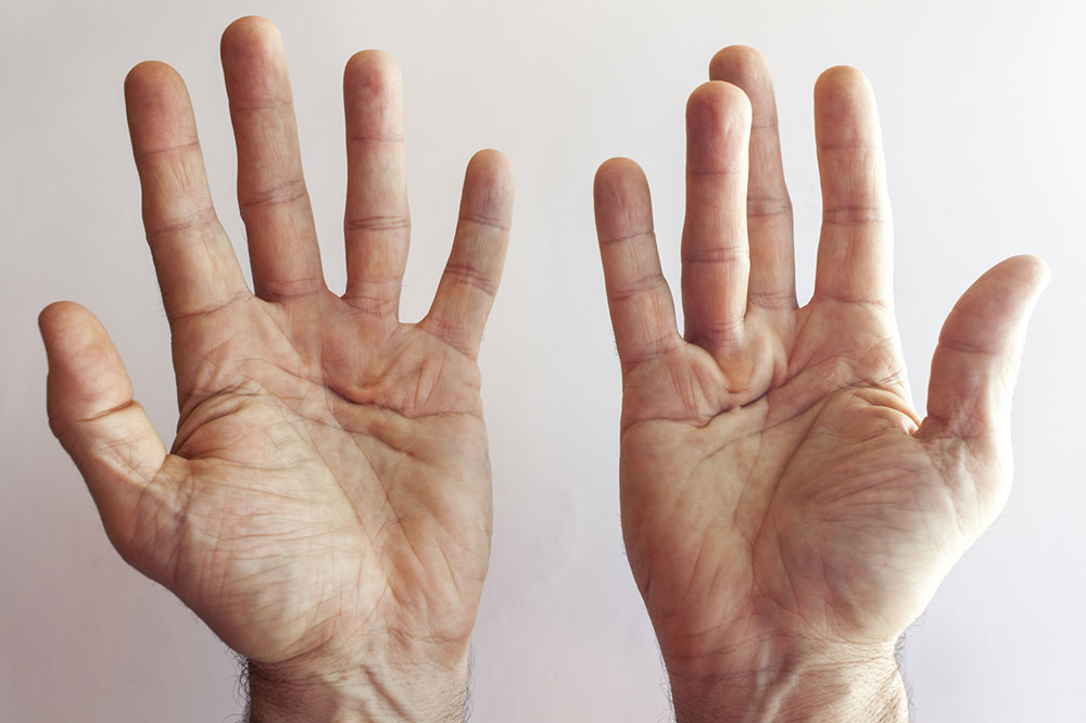 4 hand exercises for Dupuytren’s contracture patients
