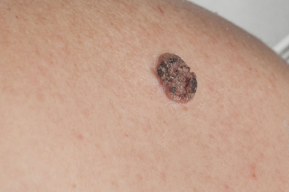 Carcinoma – Types, symptoms, and other important information you should know